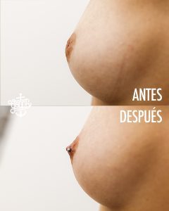 Antes Y Después 01
